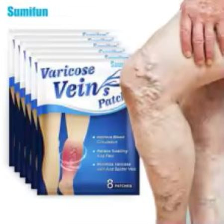 Varicose Veins – Overview